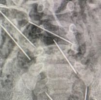 Un bebé se tragó ocho agujas, tuvieron que operarlo de urgencia y está grave
