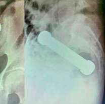 Se puso "goloso" y tuvieron que operarlo para sacarle una mancuerna del cuerpo