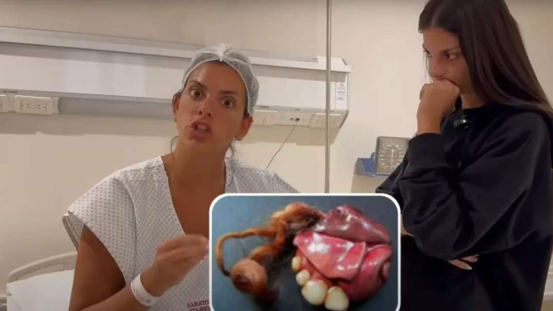 Qué es un teratoma, el tumor con pelos y dientes que le extirparon a Belu Lucius