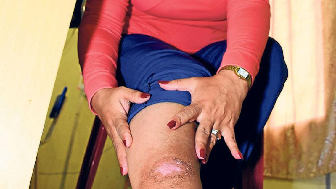 ALERTA LEISHMANIASIS ya hay más de 10 casos en Jujuy