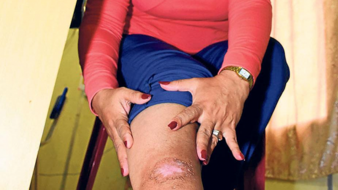 Alerta Leishmaniasis, más de 10 casos en Jujuy. Los síntomas: