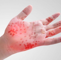 Síndrome de manos-pies-boca, el virus que ataca a los más chicos ahora que hace frío